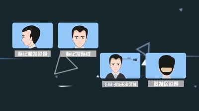 毛发移植移植之后有哪些注意事项呢