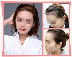 女性植发效果图
