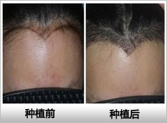 沈阳哪家医院种植<a href=http://www.chinamaofa.com/meirenjianzz/ target=_blank class=infotextkey>美人尖</a>的效果好